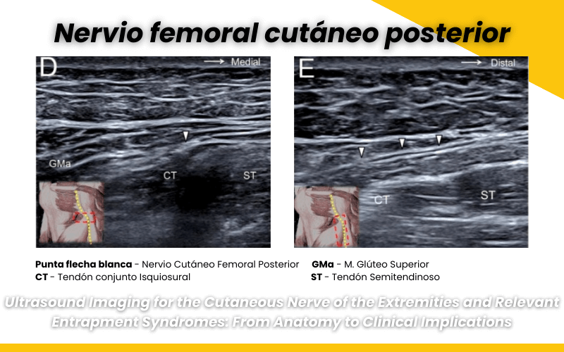 2. Nervio femoral cutaneo posterior ecografia tempo formacion.png